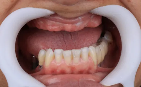 Antes - Prótese Protocolo